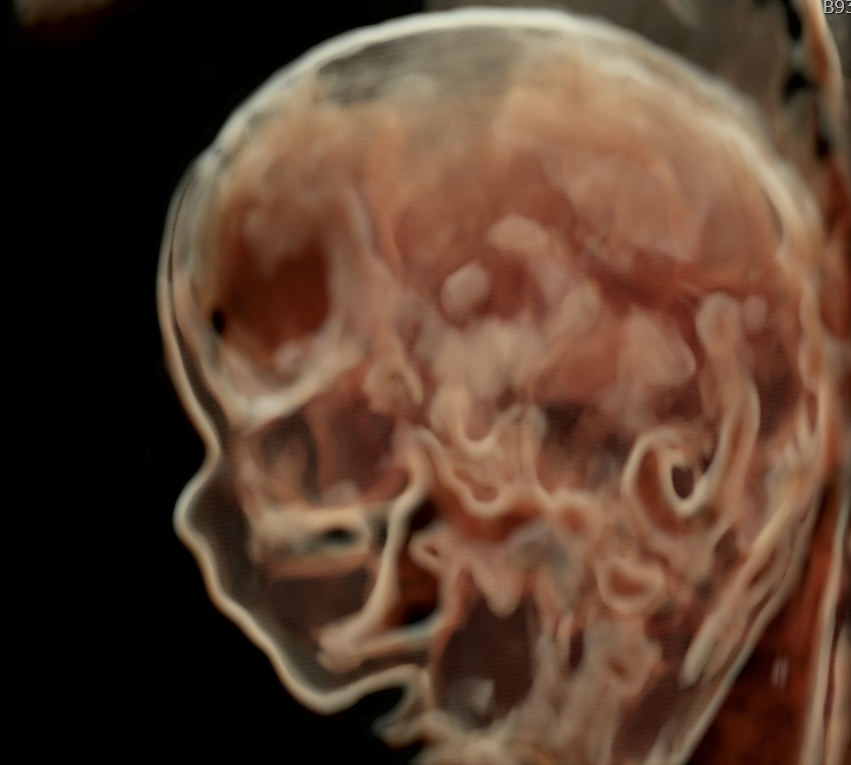 Foto de Ultrassonografia Morfológica de primeiro trimestre